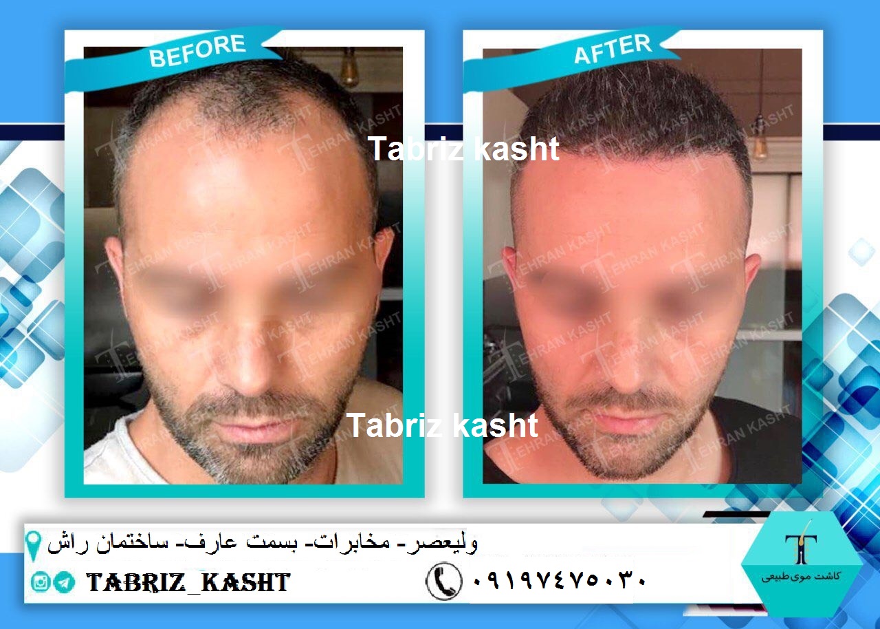 تبریز کاشت عکس شماره 2