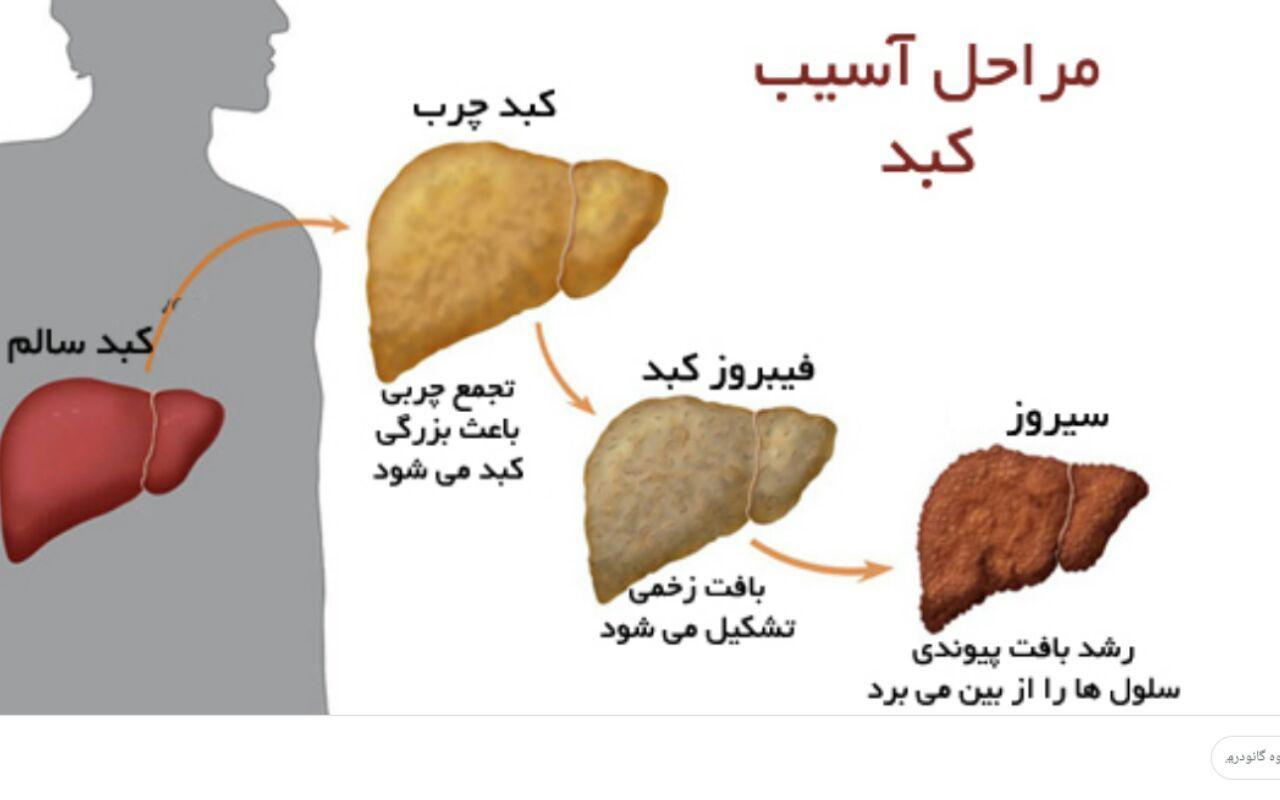 درمان قطعی کبد چرب ، بیماری خاموش! عکس شماره 3