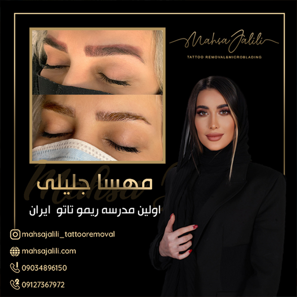 آموزش ریموو تاتو با بهترین استاد  عکس شماره 5