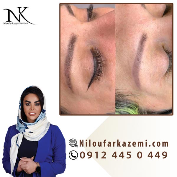 ریموو تاتو قدیمی در بهترین مرکز ریموو تاتو عکس شماره 3