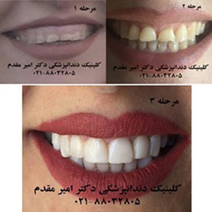دندانپزشک ملاصدرا دکتر امیر مقدم  02188032805 لامینیت دندان،ایمپلنت دندان،اصلاح طرح لبخند،کاشت دندان