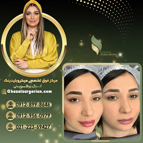 میکروبلیدینگ غزل زرگریان در تهران عکس شماره 4