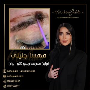 آموزش ریموو تاتو خط چشم با بروزترین تکنیک