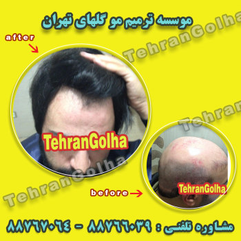 روشی نوین در ترمیم مو