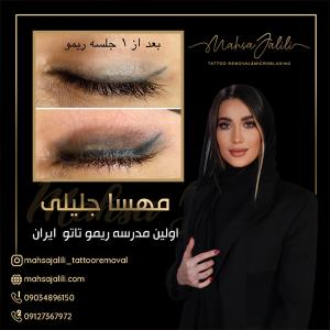 آموزش ریموو تاتو خط چشم با بروزترین تکنیک