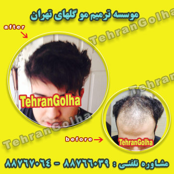 روشی نوین در ترمیم مو