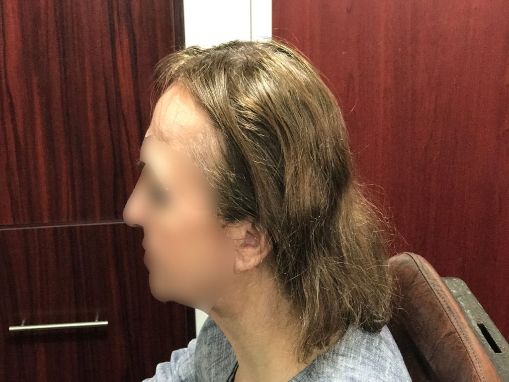 کلينيک تخصصي بهترين مو با جديد ترين روش ترميم مو
