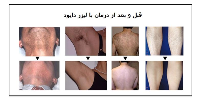 لیزر دایود(DIODE LASER)