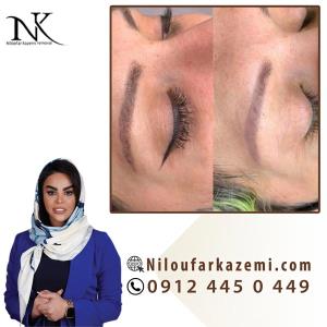 ریموو تاتو قدیمی در بهترین مرکز ریموو تاتو